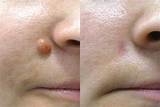 Skin Tag Removal Doctor Images