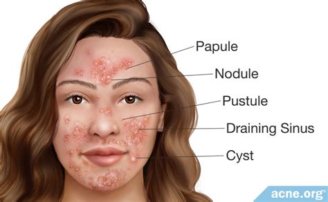 What Is Pyoderma Faciale