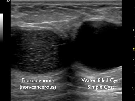 Fibroadenoma Breast Ultrasound Cancer Vs Benign Slideshare