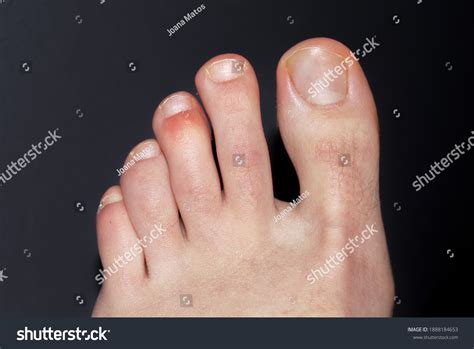 Bruised Red Swollen Middle Toe On Stock Photo 1888184653 Shutterstock