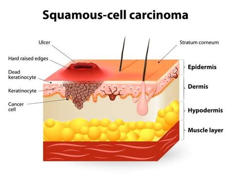 Squamous Cell Carcinoma Source Genetic Home Reference Download