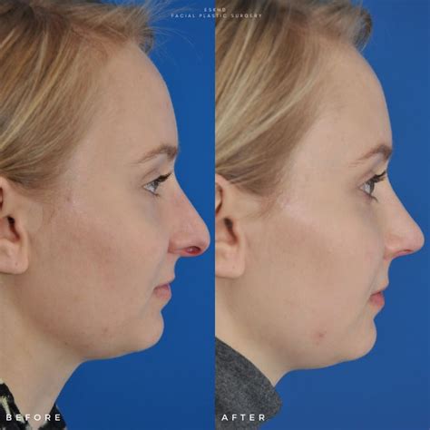 rhinoplasty nose job before and after
