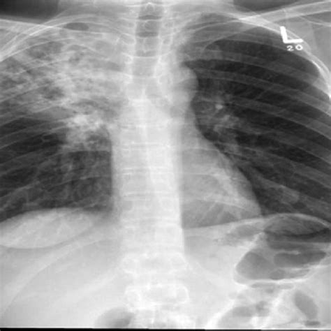 A Chest X‑ray Showing Right Hemithorax Consolidation B Chest