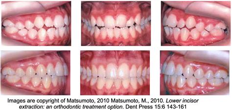 Lower Incisor Extraction In Orthodontics Dastardly Or Excellence