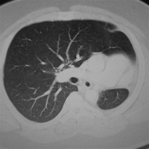 Ct Showing Hypoplastic Left Lung With Right Lung Hyperinflation And