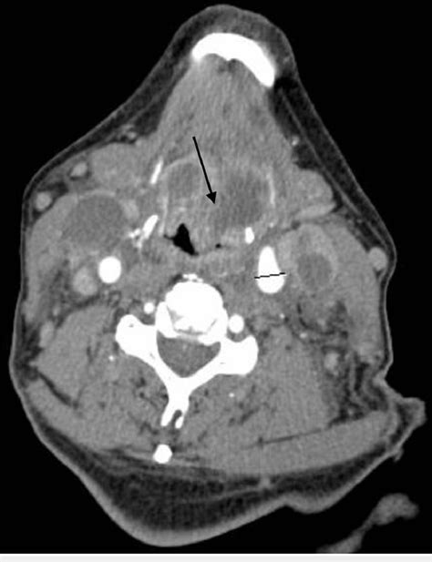Bilateral Necrotic Cervical Lymph Nodes On Ct Angiogram With Iv
