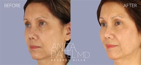 Beverly Hills Venus Versa Ipl Photofacial Intense Pulsed Light