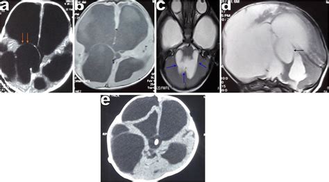 Ae Images Of The Patient Described In Case 3 A Preoperative Ct Scan