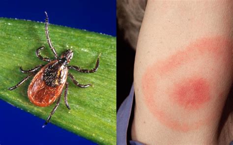 Next Generation Lyme Disease Tests Found Efficacious And Ready For