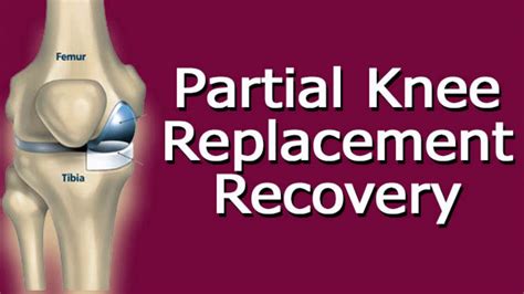 Partial Knee Replacement Recovery Youtube