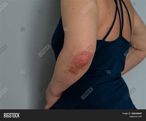 Psoriasis Elbow