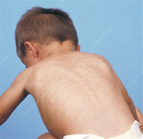 Measles Rash Stock Image M2100222 Science Photo Library