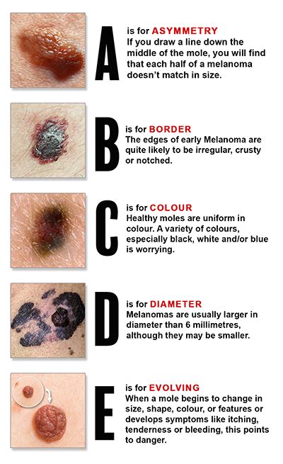 Melanoma Symptoms Abcde Detecting Skin Cancer Early Doctor Heck
