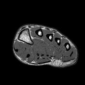 Mri with hardware in foot? Flexor digitorum brevis muscle | Radiology Reference ...