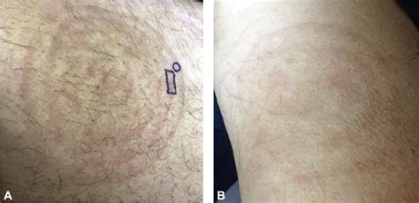 Mycosis Fungoides Presenting As Symmetric Concentric Patches Mimicking