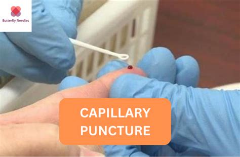 Capillary Puncture