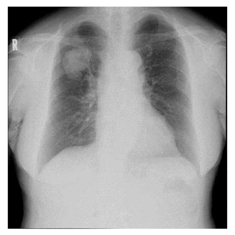 Routine Chest X Ray Examination Shows A Large Coin Lesion In The Right