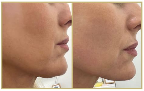 Hifu Bedford Nue Skin And Laser Clinic