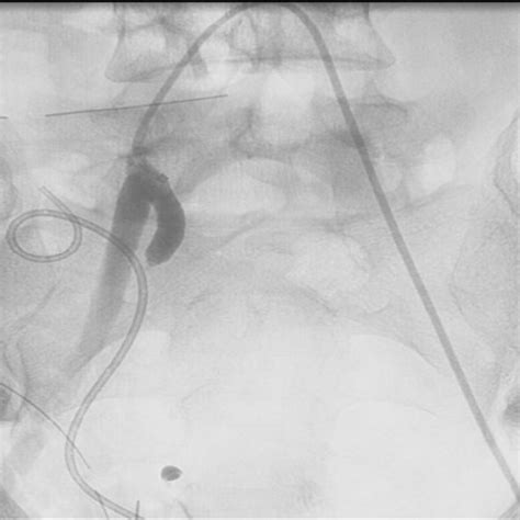 Angiogram After Angioplasty Of The Right External Iliac Showing Low