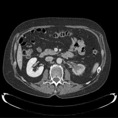 Enhanced Abdominal Computed Tomography Ct Findings Enhanced