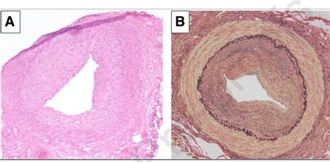 Histological Findings Of The Left Temporal Artery In A Patient With