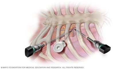 Minimally Invasive Heart Surgery About Mayo Clinic