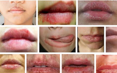 Lip Dermatitis Or Eczema On The Lip Is An Inflammatory Skin Condition