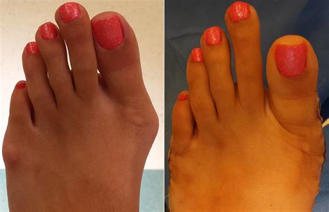 Theleafvacuum Surgery For Bunions Before And After