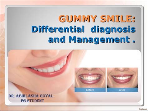 Differential Diagnosis And Management Of Gummy Smile