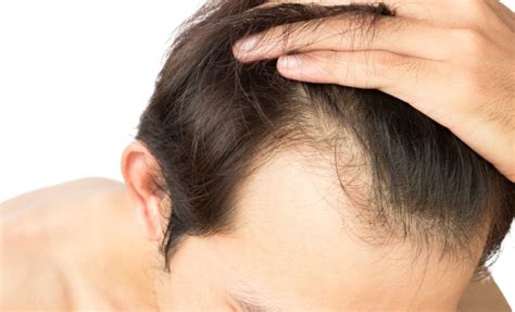 Hair Loss In Men Mumbles Clinic
