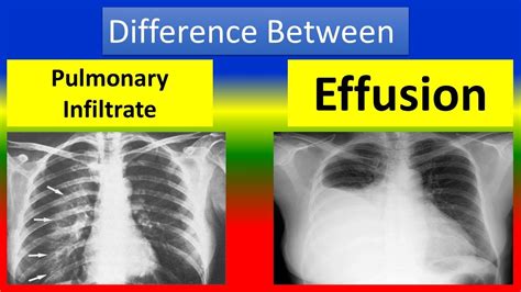 Difference Between Pulmonary Infiltrate And Effusion Youtube