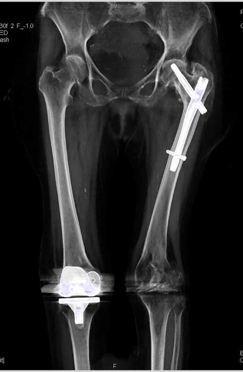 Distal Femoral Fracture