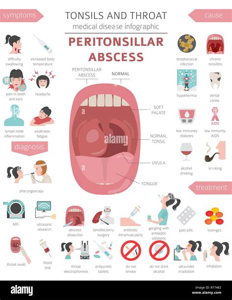 Tonsils And Throat Diseases Peritonsillar Abscess Symptoms Treatment