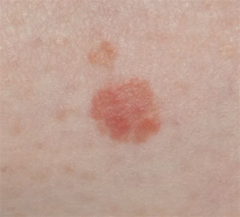 Skin Cancer Lesions Images