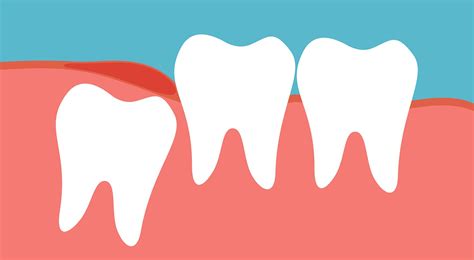 What Should You Do About A Wisdom Tooth Cavity • Neoadviser