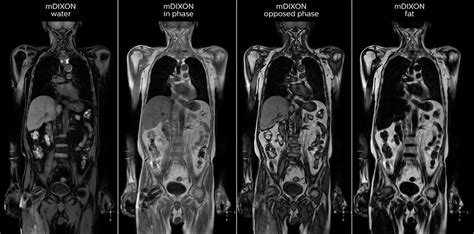 Whole Body Mri For Oncology Patients Fieldstrength Philips