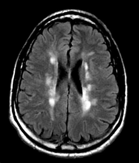 Brain mri scan showing white lesions associated with multiple sclerosis. Multiple sclerosis MRI - wikidoc