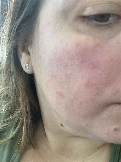 Does Anyone Get This Type Of Rash From Histamine Intolerance I Havent