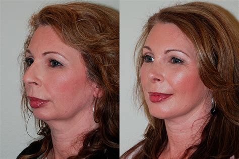Chin Implant Before And After