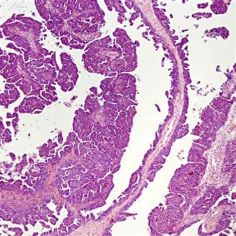 Left Inguinal Node Biopsy Showing Metastatic Papillary Serous Carcinoma