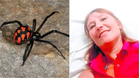 Warning Expat Hospitalised After Savage Spider Bite Caused Her Skin