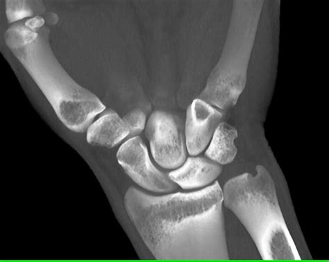 High Resolution 3d Mapping Of The Carpal Bones Musculoskeletal Case