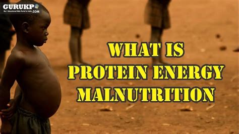 Protein Energy Malnutrition Overview Symptoms Prevention And More