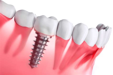 Distintos Tipos De Implantes Dentales Somos Dent