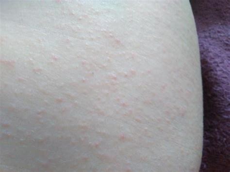 Pin Head Size Rash Still Spreading After 4 Weeks Netmums Chat