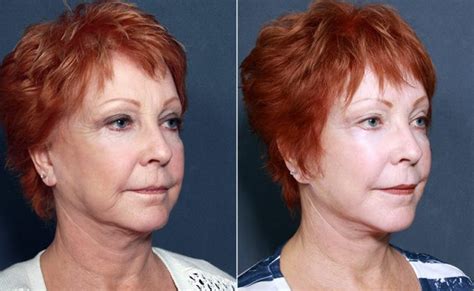 Dr Roark Mini Facelift And Neck Lift La Jolla Cosmetic Surgery Centre