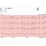 Baseline EKG Showing QTc Prolongation With Largely Normal T Wave 
