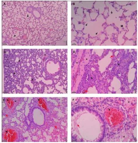 Histopathology Of Lung Tissue Of Control Renal Malaria And Cerebral