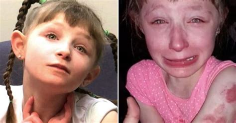 Year Old Girl Who Cannot Speak Was Left Covered In Bite Marks After