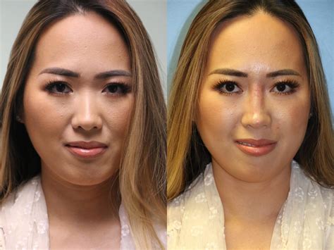 Non Surgical Rhinoplasty Photos Chevy Chase Md Patient 11854